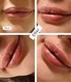0 a hyaluron pen  juvederm läppar leilasspa.jpeg