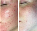 0 b mezotix före och efter leilasspa 29 acne.jpg