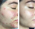 0 b mezotix före och efter leilasspa  13  acne.jpg