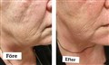 0 c fractional rf leilasspa 3.jpg