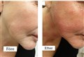 0 fractional rf- laser leilasspa 6.jpg