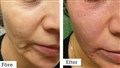 0 fractional rf- laser leilasspa 7.jpg