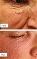 0 fractional rf- laser leilasspa 9.jpeg