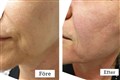 0 fractional rf leilasspa 18..jpg