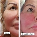 0 fractional rf leilasspa före och efter 1.jpeg