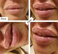 0 juvederm läppar russian leilasspa  g..jpg