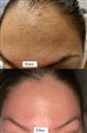 1 mezotix acne behandling leilasspa.jpeg