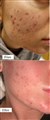 1 mezotix acne behandling leilasspa 1.jpeg