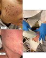 1 mezotix acne behandling leilasspa 3.jpeg