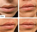 fillers hyaluronpen.jpeg