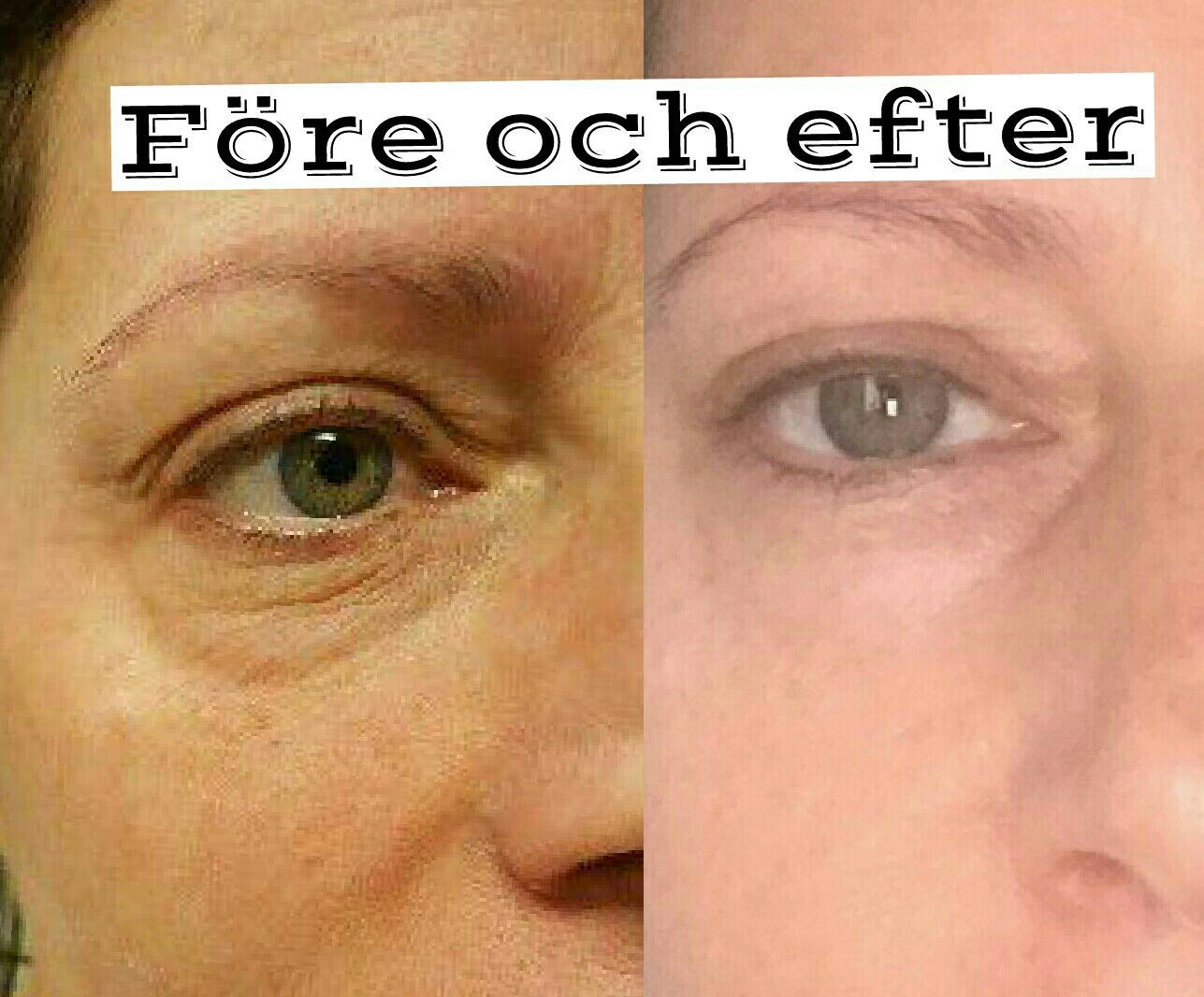 carboxy therapy biverkningar carboxy therapy biverkningar